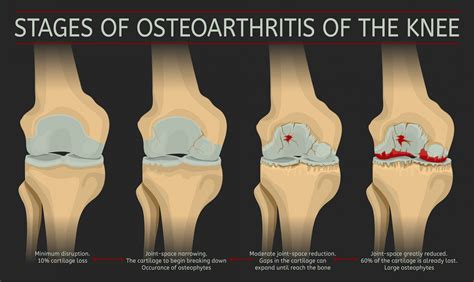 osteoarthritis icd 10|More.